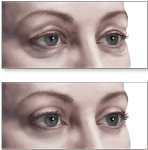 Rejuvenescendo as pálpebras